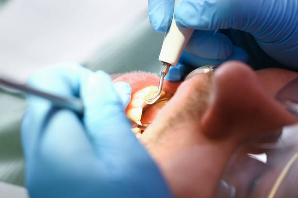 Best Emergency Root Canal Treatment in New Castle, PA